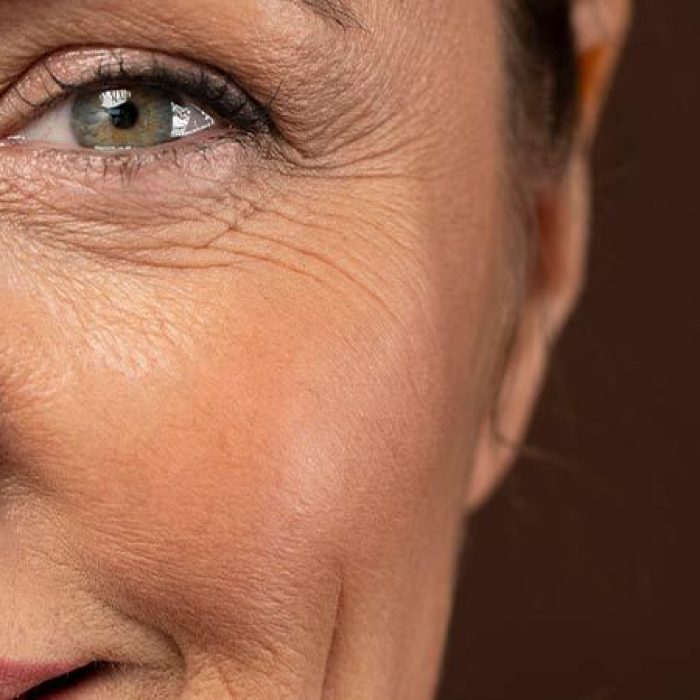 Fine-lines-Wrinkles-1